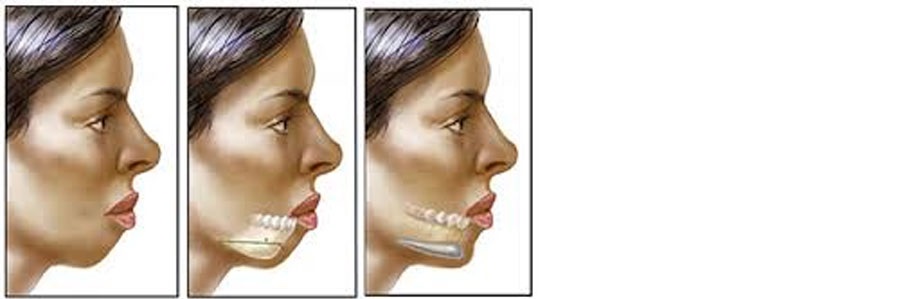 برجسته سازی چانه  chin augmentation