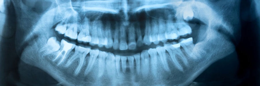 مزایای یک معاینه رادیوگرافیک دندانپزشکی (با اشعه X) چیست؟