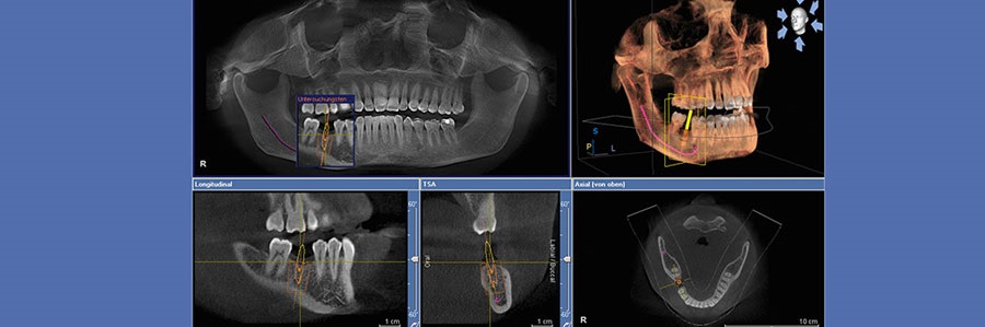 استفاده از cbct در دندان پزشکی