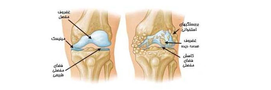 تعویض مفصل زانو