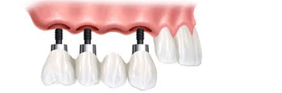 ایمپلنت دندانی   Dental implant