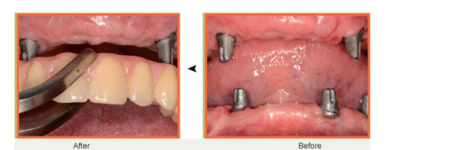 اصلاح بی دندانی کامل با ایمپلنت