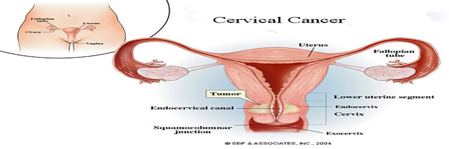 hpv چیست ؟