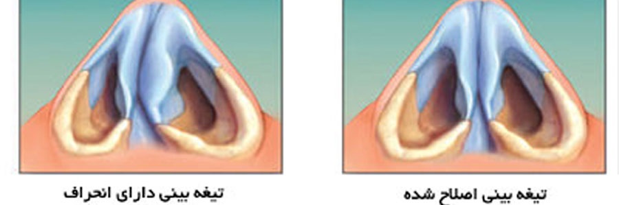 سپتوپلاستی (جراحی انحراف تیغه بینی)