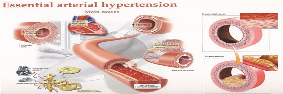 فشار خون بالا (هیپرتانسیون HYPERTENTION)