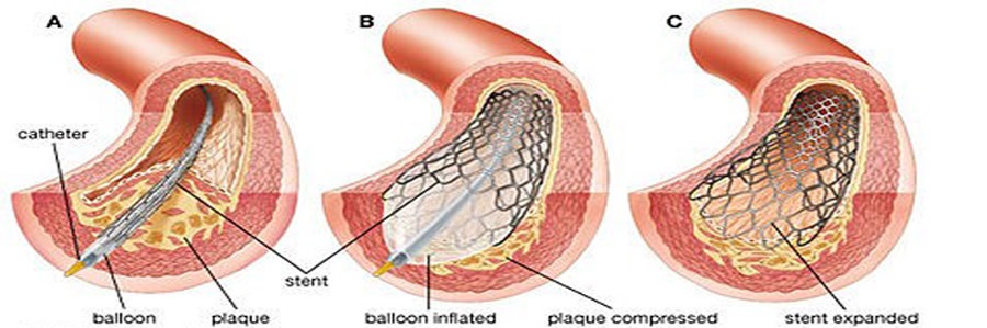 احتمال سکته مجدد پس از کارگذاشتن استنت دارویی تا 7درصد است