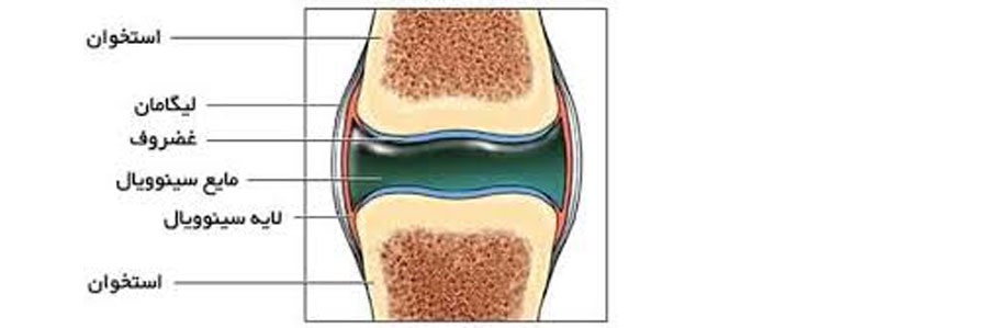 علت کم شدن آب داخل زانو چیست؟ چکار کنیم تا مایع درون مفصل زانو یا همان آب داخل زانو زیاد شود؟