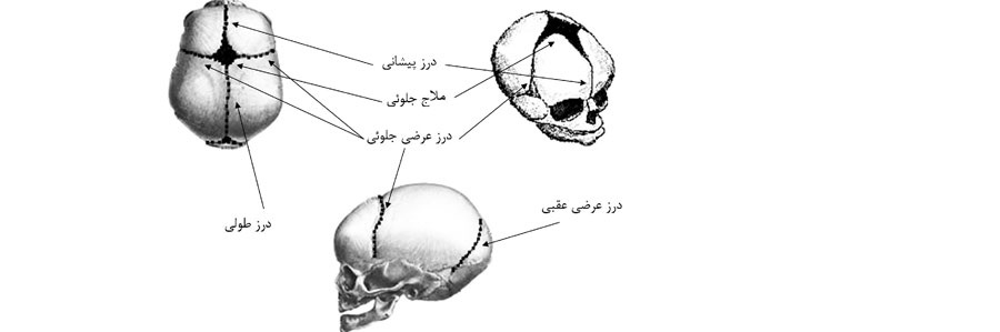 کرانیو سین استوز یا بسته شدن زودتر از موعد درزهای جمجمه