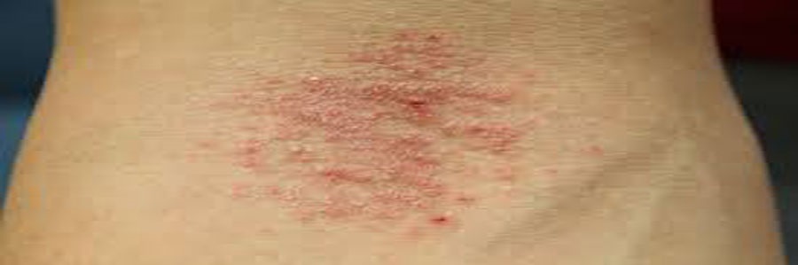 اگزما از شایع‌ترین بیماری‌های پوستی در فصل سرماست