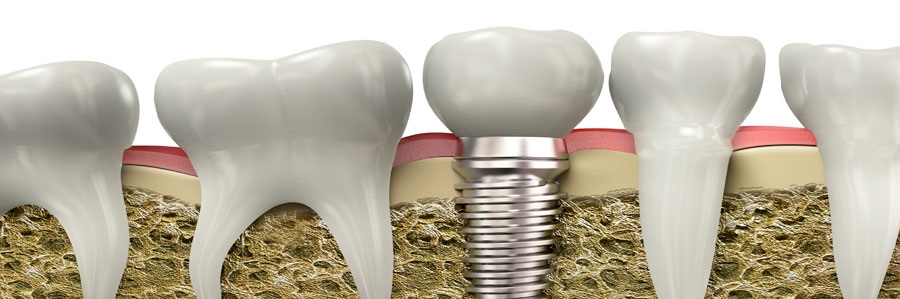 ایمپلنت های دندانی بدون فلپ جراحی و بخیه