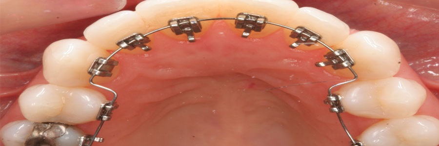 ارتودنسی نامرئی همرنگ دندان