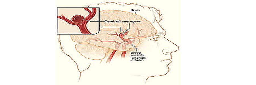 آنوریسم مغزی چیست؟