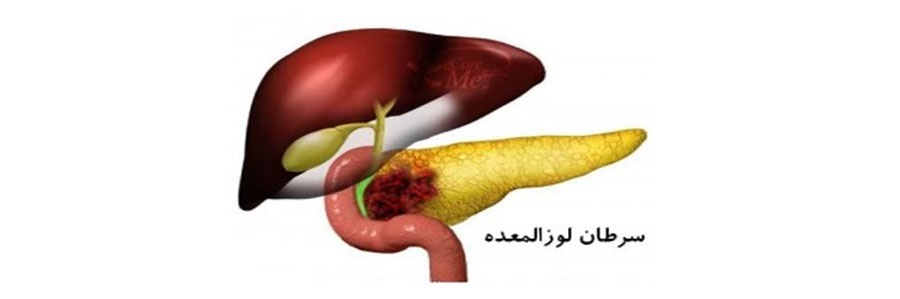 سرطانی که با سوزش معده اشتباه گرفته می شود