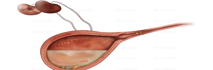 سرطان مثانه در کمین چه کسانی است