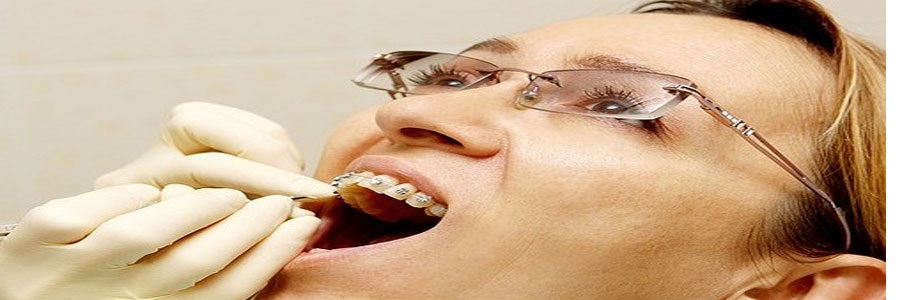 آیا کسانی که دندانشان روکش دارد هم می توانند ارتودنسی کنند؟