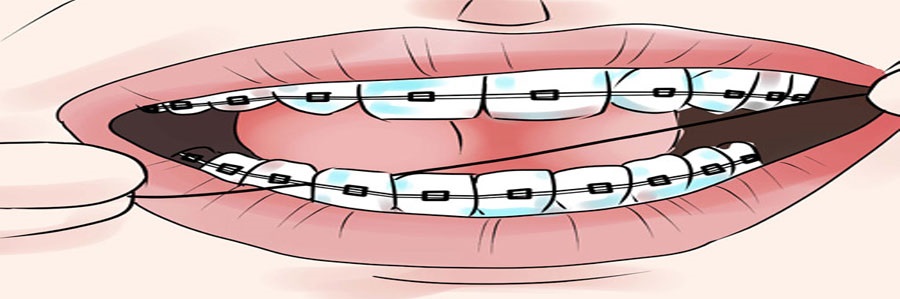 توصیه دکتر سعید قریشی به استفاده از نخ دندان در کنار سیم‌های ارتدنسی
