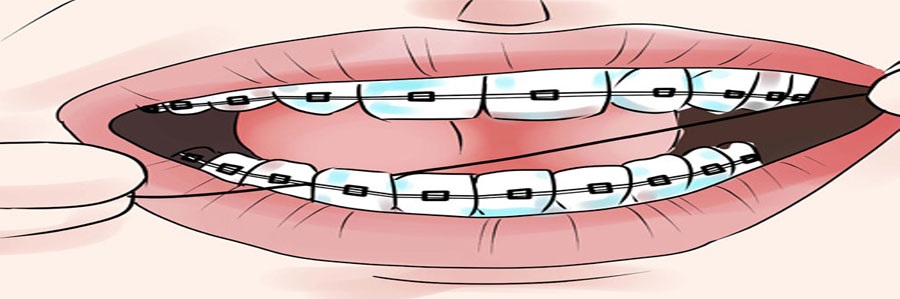 آموزش بهداشت در خانه در زمانی که تحت درمان ارتودنسی هستید