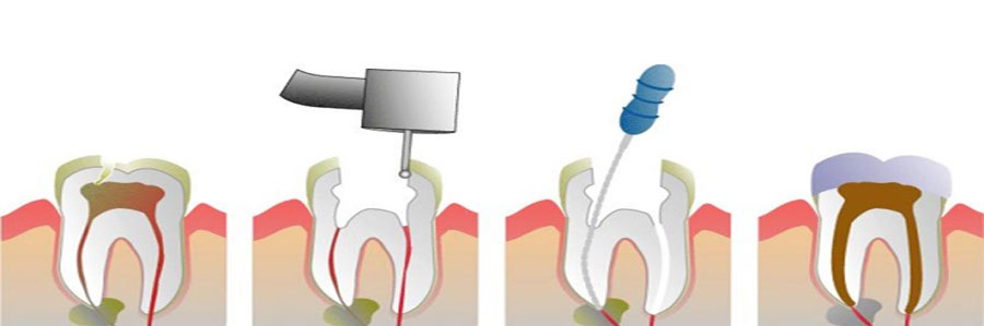 درمان ریشه دندان