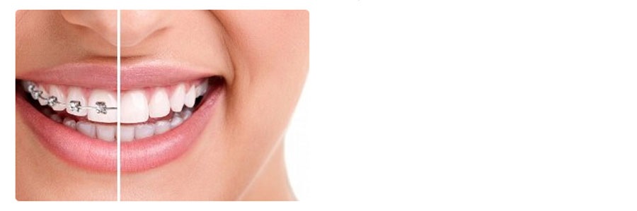 درباره ارتودنسی نامرئی بیشتر بدانیم