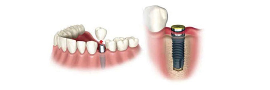مراحل کاشت ایمپلنت‌های دندانی