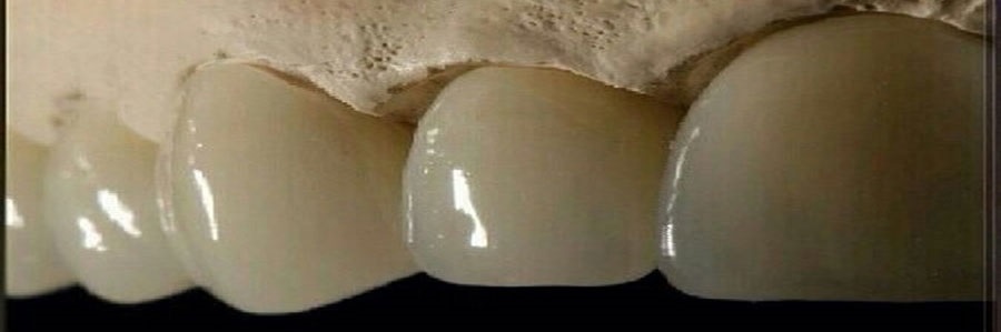لامینیت های دندانی