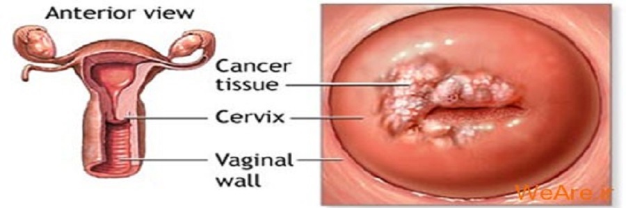 سرطان دهانه رحم در زنان