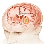 تومور مغزی چیست؟