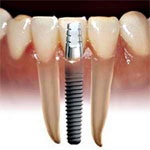 ایمپلنتهای دندانی