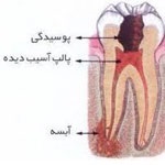 عصب کشی چیست؟