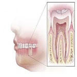 عصب کشی دندان و درمان ریشه چیست؟