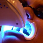 سفید کردن دندان ها