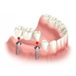 آنچه شما باید درباره ایمپلنت دندان بدانید