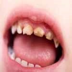 در کودکانی که از آب شرب استفاده نمی کنند، علی رغم پایین بودن سطح سرب در خون، میزان پوسیدگی دندان بالاست