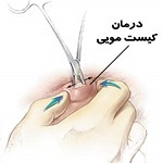 کیست پایلونیدال چیست و بهترین روش درمانی چیست ؟