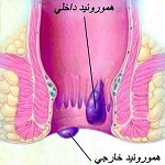 درمان شقاق