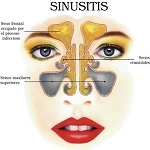 سینوزیت چیست و چگونه درمان میشود؟