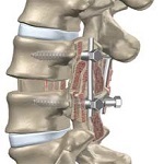 عمل جراحی فیوژن (خشک کردن ستون مهره )