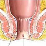 درمان بیماریهای مقعد(مخرج)-همورئید-شقاق-فیستول-کیست مویی