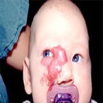 آسیب بافت نرم صورت در کودکان