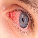 انتخابی جدید دردرمان بیماریهای التهابی چشم واربیت