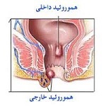هموروئید چیست؟