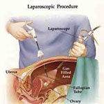Laparoscopic management of ureteropelvic junction obstruction by division of anterior crossing vein and cephalad relocation of anterior crossing arter