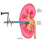 Experience of percutaneous nephrolithotomy using adult-size instruments in children less than 5 years old.