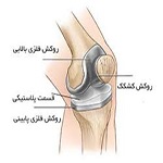 پرسش های مهم در خصوص تعویض مفصل زانو