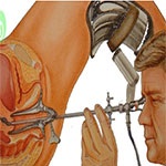 هیستروسکوپی چیست