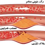 آترواسکلروز (تصلب شرائین)