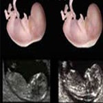 سونوگرافی در حاملگی