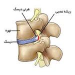 درمان فتق دیسک بین مهره ای