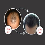 فاکتورهایی که توسط متخصص پوست و مو  در انتخاب متقاضیان کاشت مو مد نظر قرار می گیرند؟