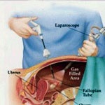 عمل های لاپروسکمی